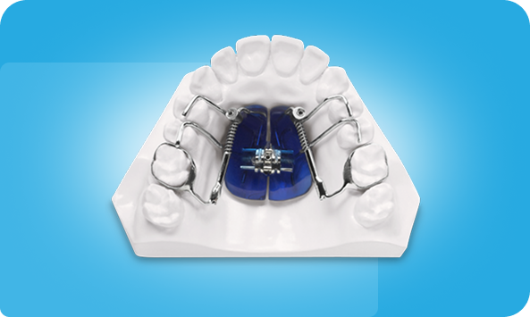 M-Slider Distalization Appliance